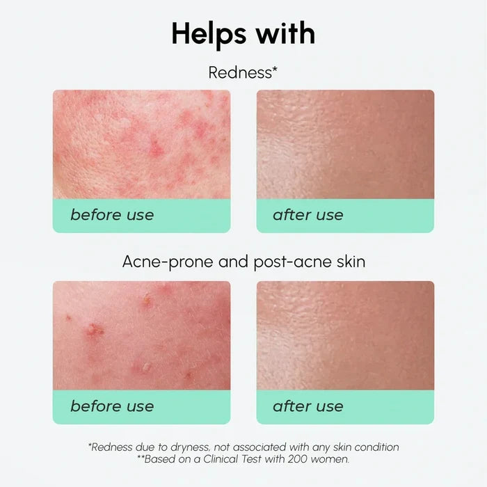 Redness Soothing Azelaic Acid Serum
